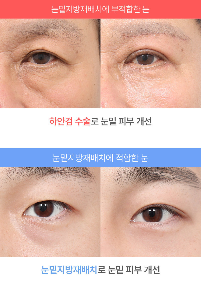 눈 밑 지방제거 수술, 수술 전 꼭 알아야 할 핵심 포인트