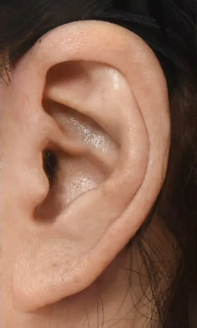 리프팅 귀흉터 수술 전