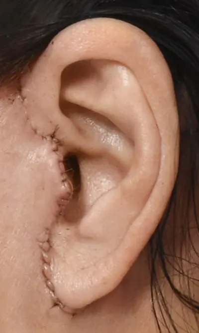 리프팅 귀흉터 수술 후 흉터