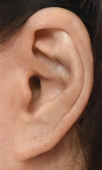 리프팅 수술 후 흉터 및 귀모양