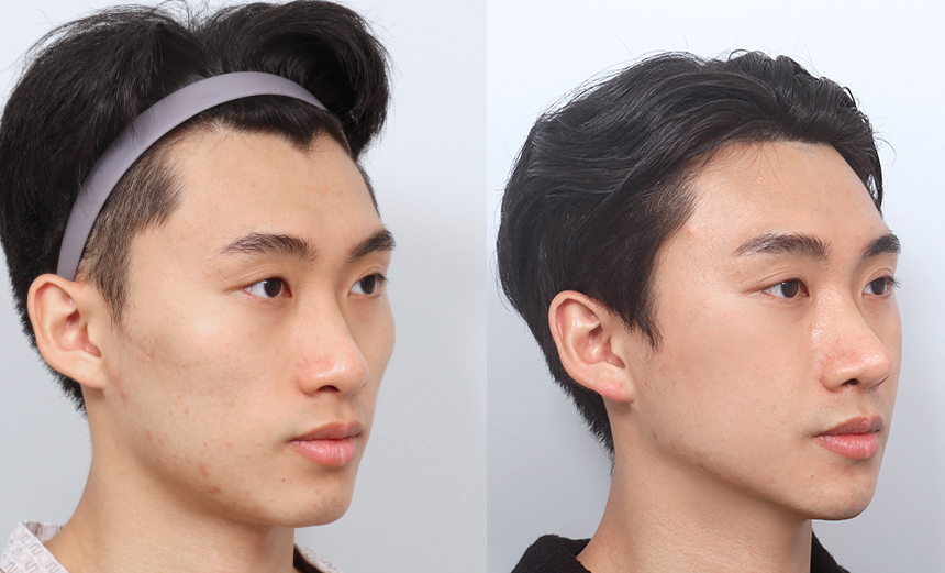 남자 안면윤곽 - 예쁘게 나답게, 에이비 성형외과 남자 안면윤곽 - 예쁘게 나답게, 에이비 성형외과